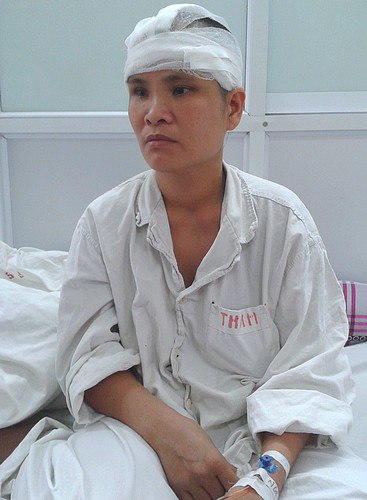 Nối th&agrave;nh c&ocirc;ng mảnh da đầu cho người bị m&aacute;y cuốn 2