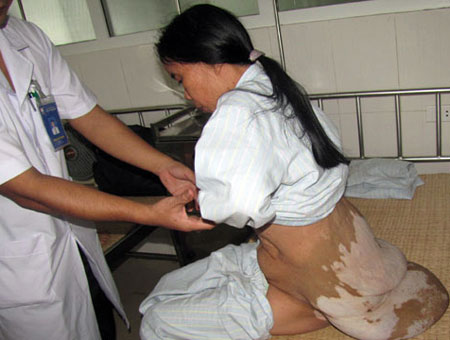 Tận thấy những khối u "hãi hùng" nhất Việt Nam 8 Tận thấy những khối u "hãi hùng" nhất Việt Nam 8