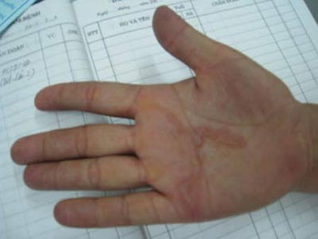 Gh&ecirc; rợn giun "tự do" b&ograve; lổm ngổm dưới da 1