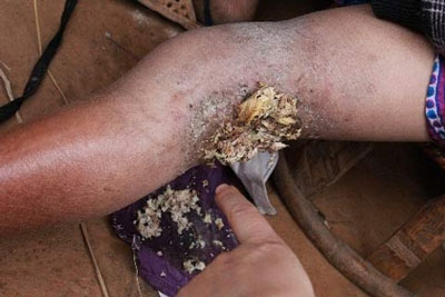 B&eacute; g&aacute;i 3 năm sống với c&aacute;i ch&acirc;n l&uacute;c nh&uacute;c gi&ograve;i 2