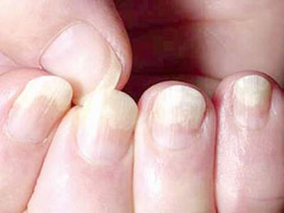 Dấu hiệu bệnh qua màu sắc móng tay 10 Dấu hiệu bệnh qua màu sắc móng tay 10