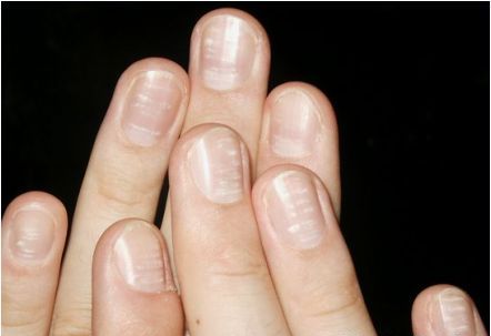 Dấu hiệu bệnh qua màu sắc móng tay 11 Dấu hiệu bệnh qua màu sắc móng tay 11