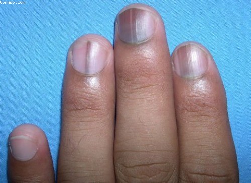 Dấu hiệu bệnh qua màu sắc móng tay 14 Dấu hiệu bệnh qua màu sắc móng tay 14