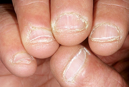 Dấu hiệu bệnh qua màu sắc móng tay 9 Dấu hiệu bệnh qua màu sắc móng tay 9