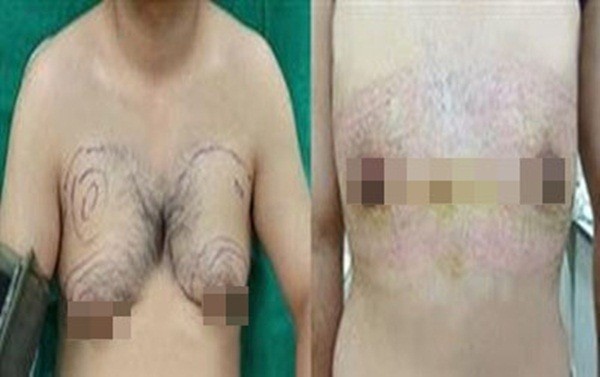 Ch&agrave;ng trai c&oacute; bộ ngực to hơn v&ograve;ng 1 của bạn g&aacute;i 2