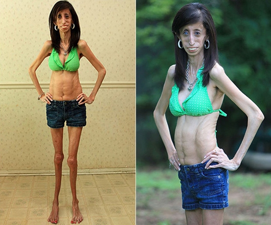 Những c&ocirc; g&aacute;i gầy giơ xương chiến đấu với bệnh biếng ăn 8