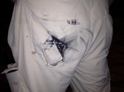 Bỏng... lạ v&igrave; pin điện thoại nổ tung trong quần 1