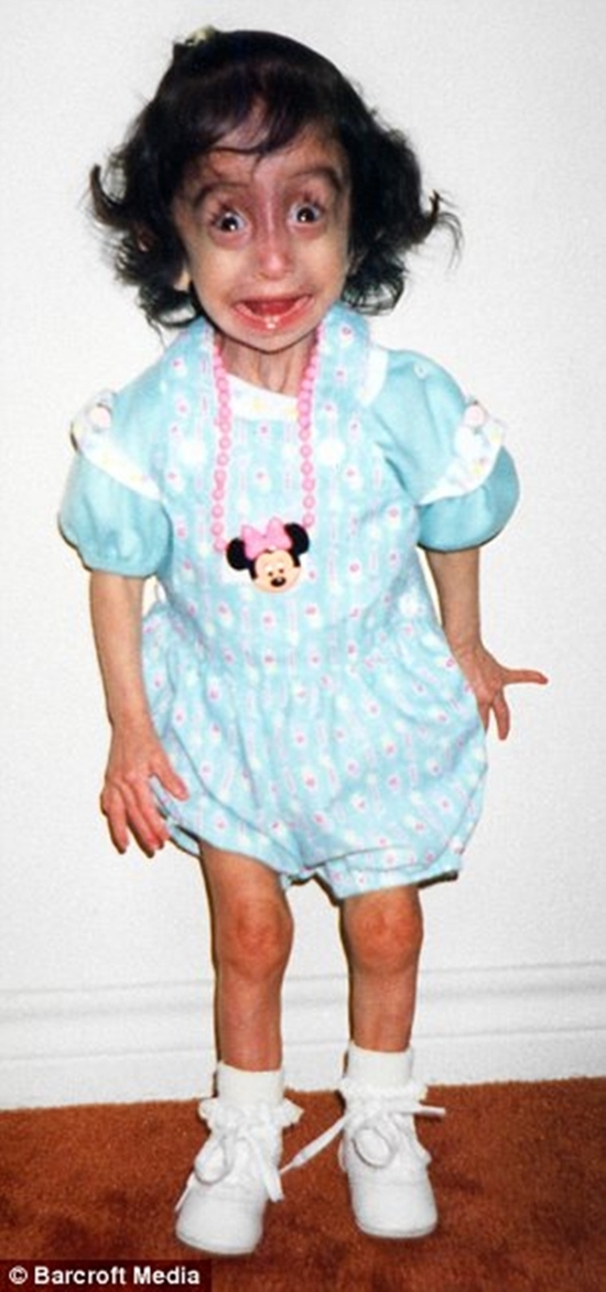 Những c&ocirc; g&aacute;i gầy giơ xương chiến đấu với bệnh biếng ăn 11