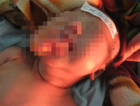 Quảng B&igrave;nh: B&eacute; sơ sinh c&oacute; lưỡi như ch&ugrave;m nho 1