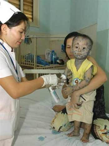 Những bệnh ở trẻ cần lưu &yacute; trong th&aacute;ng 3 1