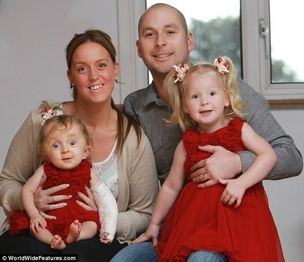 B&eacute; g&aacute;i "b&uacute;p b&ecirc;" ch&agrave;o đời với 30 chiếc xương g&atilde;y 3