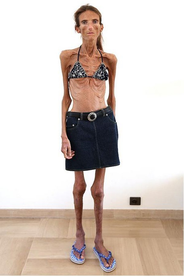 Những c&ocirc; g&aacute;i gầy giơ xương chiến đấu với bệnh biếng ăn 6