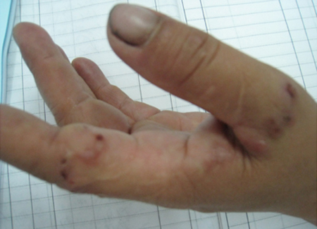 H&agrave; Nội: Kinh h&atilde;i giun l&uacute;c nh&uacute;c dưới da một phụ nữ  3