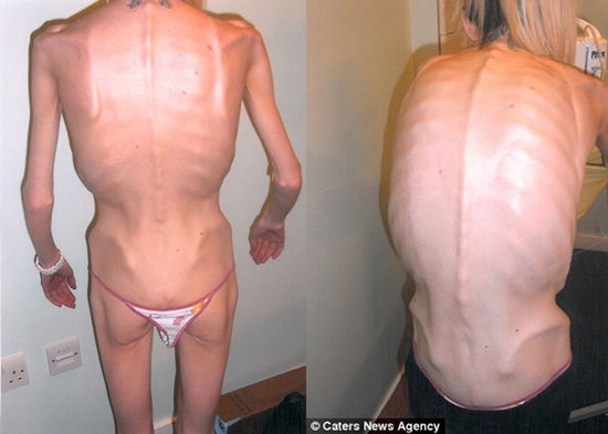 Những c&ocirc; g&aacute;i gầy giơ xương chiến đấu với bệnh biếng ăn 13