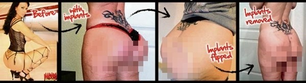 V&ograve;ng 3 biến dạng khủng khiếp sau phẫu thuật cấy gh&eacute;p 2