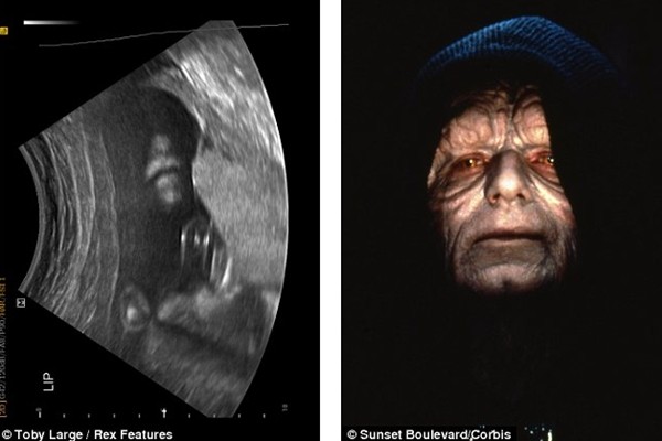 Giật m&igrave;nh ảnh si&ecirc;u &acirc;m thai nhi giống "Ch&uacute;a tể hắc &aacute;m" 1