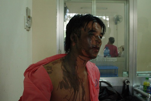 Hai vợ chồng bị tạt axit trong đ&ecirc;m 1