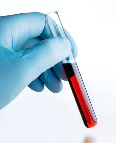 Phương ph&aacute;p mới ph&aacute;t hiện sớm ung thư buồng trứng 1