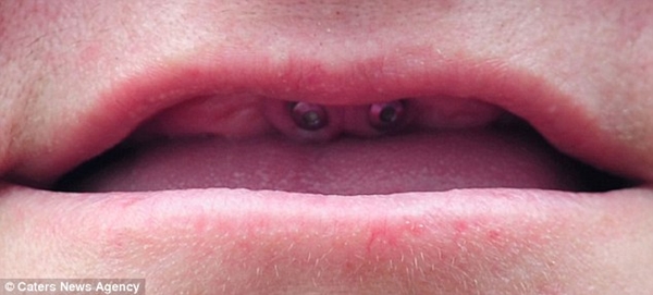 B&eacute; g&aacute;i c&oacute; h&agrave;m răng "kinh dị" bọc to&agrave;n kim loại 6