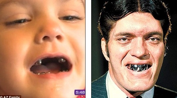 B&eacute; g&aacute;i c&oacute; h&agrave;m răng "kinh dị" bọc to&agrave;n kim loại 3