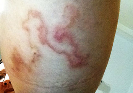 H&agrave; Nội: Kinh h&atilde;i giun l&uacute;c nh&uacute;c dưới da một phụ nữ  4