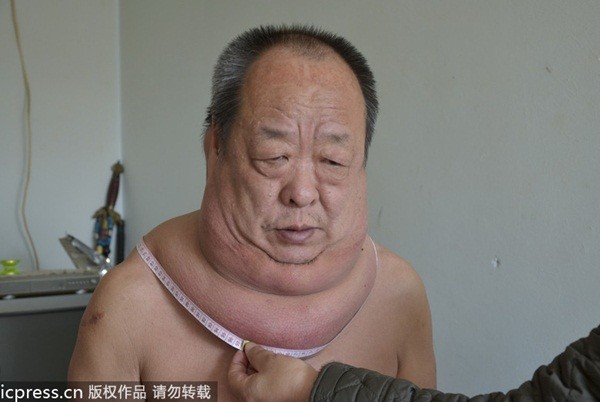 Người đ&agrave;n &ocirc;ng với chiếc cổ "ph&aacute;t ph&igrave;" kỳ lạ 1