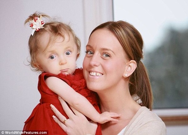 B&eacute; g&aacute;i "b&uacute;p b&ecirc;" ch&agrave;o đời với 30 chiếc xương g&atilde;y 5