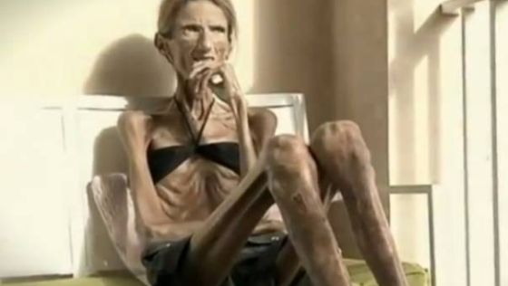 Những c&ocirc; g&aacute;i gầy giơ xương chiến đấu với bệnh biếng ăn 4