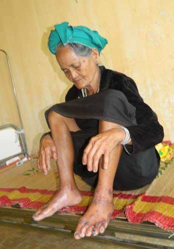 Bệnh &lsquo;lạ&rsquo; lại b&ugrave;ng ph&aacute;t dữ dội tại Quảng Ng&atilde;i 1