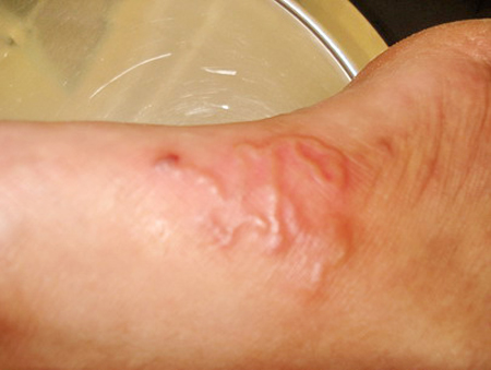 H&agrave; Nội: Kinh h&atilde;i giun l&uacute;c nh&uacute;c dưới da một phụ nữ  1