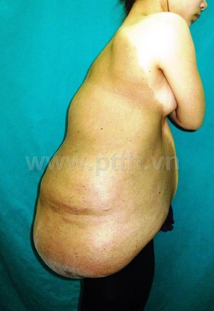 Cô gái 24 tuổi mang khối u 7kg sau lưng 1 Cô gái 24 tuổi mang khối u 7kg sau lưng 1