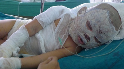 Nổ b&igrave;nh ga, 1 người chết, 6 người bỏng nặng 2