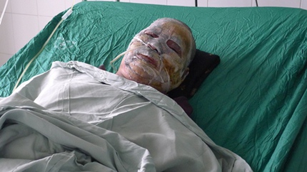 Nổ b&igrave;nh ga, 1 người chết, 6 người bỏng nặng 4