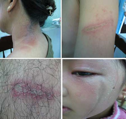 Rợn người h&igrave;nh ảnh lở lo&eacute;t da do c&ocirc;n tr&ugrave;ng 1