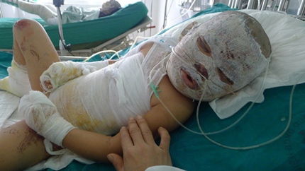 Nổ b&igrave;nh ga, 1 người chết, 6 người bỏng nặng 1