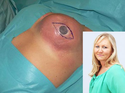 Một phụ nữ bị "nổ" ngực vì... muỗi cắn 1